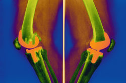 colored xray of knee replacements