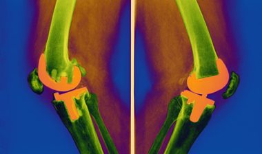 Persona TM Tibial Plate Might Come Loose and Lead to Pain, Knee Instability