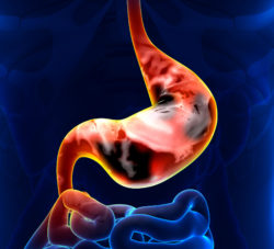 stomach cancer causes are many