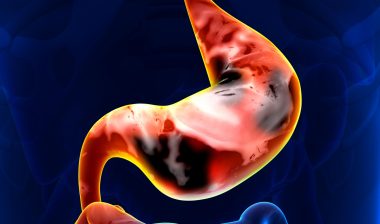 stomach cancer causes are many