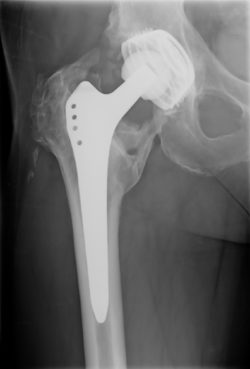 xray of DePuy ASR prosthetic hip