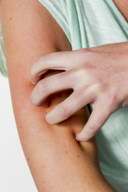 Rash Caused By Lamictal May Be a Sign of Drug-Induced Hypersensitivity Syndrome