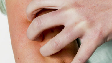 Rash Caused By Lamictal May Be a Sign of Drug-Induced Hypersensitivity Syndrome