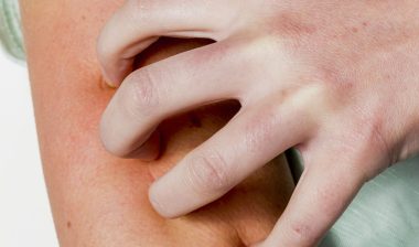 Rash Caused By Lamictal May Be a Sign of Drug-Induced Hypersensitivity Syndrome