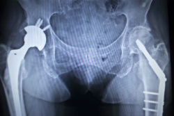 DePuy-ASR-hip-replacement-lawsuit
