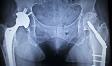 DePuy-ASR-hip-replacement-lawsuit