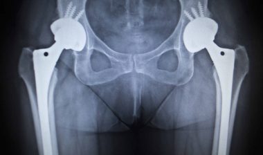 Pinnacle-acetabular-cup