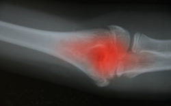 Recalled Arthrex iBalance TKA Tibial Tray Can Wreak Havoc in Knee Replacement System