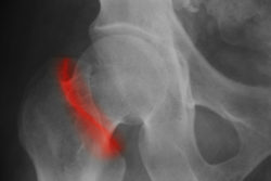 Woman Files Stryker LFIT Hip Replacement Lawsuit Over Severe Injuries, Joining MDL
