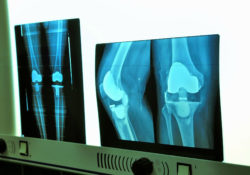 Zimmer knee implant problems may lead to revision surgery