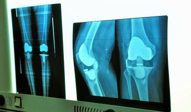 Zimmer knee implant problems may lead to revision surgery