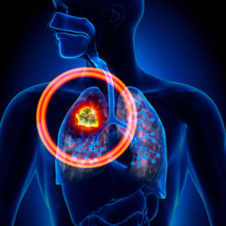 Asbestos Lung Cancer Lawsuit Possible for Workers Exposed to Asbestos on the Job