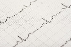 Heart Attack Symptoms Reported in Uloric Patients