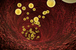 an IVC filter, or clot filter, works to prevent clots from reaching the heart or lungs