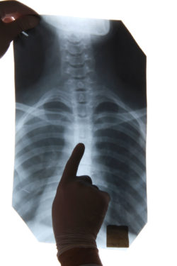 Woman Files Bard Lawsuit Alleging IVC Filter Perforation