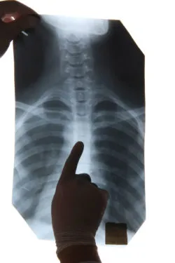 Woman Files Bard Lawsuit Alleging IVC Filter Perforation