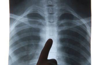 Cook Vena Cava Filter Products Are Dangerous, Lawsuit Alleges