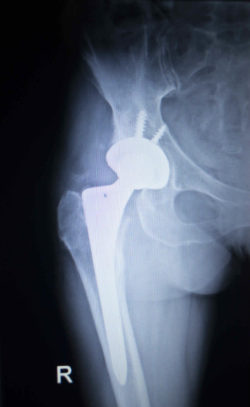 DePuy Pinnacle Hip Implant Lawsuit Claims Hip Replacement Releases Metal Ions