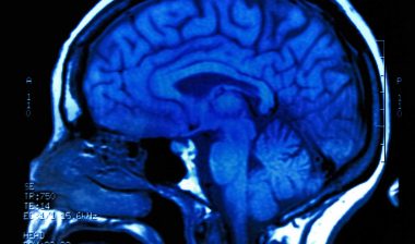 Some Patients Require Encephalitis Treatment After Taking Zinbryta, Developing Side Effects