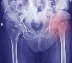 DePuy ASR Metal On Metal Hip Replacement Allegedly Prone To Failure
