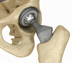 Couple Alleges Serious Problems with DePuy ASR Hip System