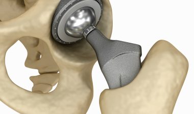 Couple Alleges Serious Problems with DePuy ASR Hip System