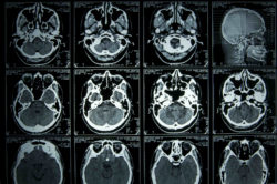 Gadolinium Brain Deposits Prompt FDA Recommendations And Call For Research