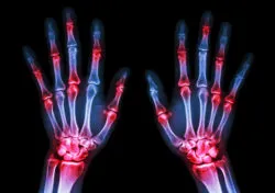 Uloric, A Takeda Gout Drug, May Cause Cardiac Symptoms, Trial Data Suggests