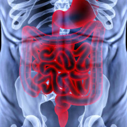 Xarelto Gastrointestinal Bleed alleged in Growing MDL