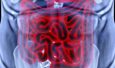 Xarelto Gastrointestinal Bleed alleged in Growing MDL