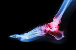 Major Cardiovascular Issues Linked with Uloric Gout Medicine