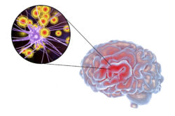autoimmune encephalopathy is a risk that Zinbryta users face