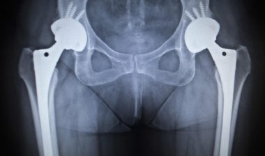 Depuy-metal-hip-implant