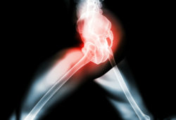 Man Files DePuy Pinnacle Lawsuit Over Alleged Device Injuries and Complications