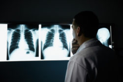 lung cancer caused by asbestos