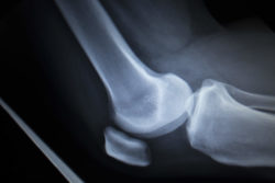 Many Patients Report Injuries from iBalance Knee Replacement Problems