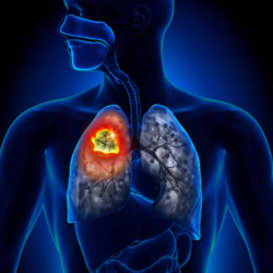 Grieving Widow Claims Husband Died from Asbestos-Related Mesothelioma Cancer