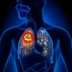 Grieving Widow Claims Husband Died from Asbestos-Related Mesothelioma Cancer