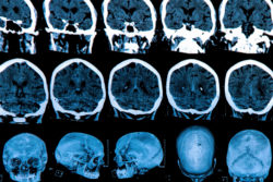 FDA Issues Warning Regarding Gadolinium Retention