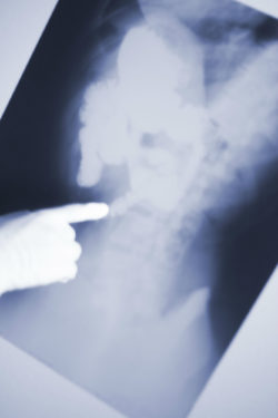 Growing MDL Allege Injuries after Stryker Hip Revision Surgery