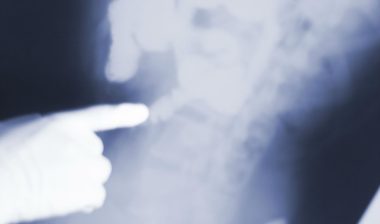 Growing MDL Allege Injuries after Stryker Hip Revision Surgery