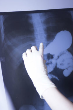 Patients Might Be Affected by ASR Hip Recall