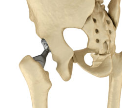Growing MDL Alleges Problems with DePuy ASR Hip Replacement
