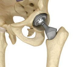 DePuy ASR hip implant system has caused problems for patients
