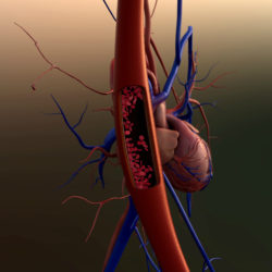 IVC filter side effects are behind the MDL facing Bard
