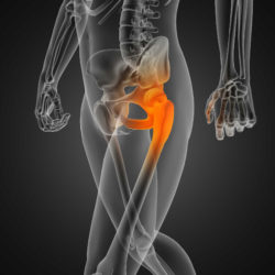 Biomet Hip Implant Lawsuit alleges Serious Device Complications