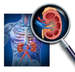 Manufacturers of Nexium Face Woman's Recent Chronic Kidney Disease Lawsuit