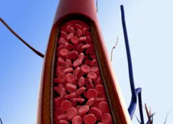 Bard Retrievable Clot Filter Allegedly Caused Severe Injuries to Inferior Vena Cava