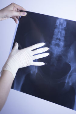 Howmedica Failed To Warn Consumers And Protect Their Safety, Stryker V40 Lawsuit Alleges