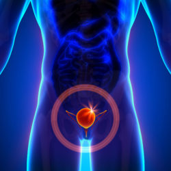 Actos Settlement Compensation May Be Available for Patients with Bladder Cancer